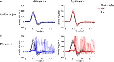 Balance in Virtual Reality: Effect of Age and Bilateral Vestibular Loss